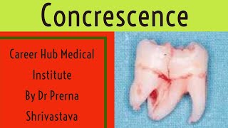 concrescence Developmental tooth anomaly By Dr Prerna Shrivastava career Hub medical institute [upl. by Aerdnu]