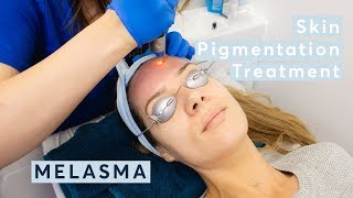 Melasma Skin Pigmentation Treatment using PicoSure Laser [upl. by Jen]