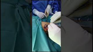 Osteochondroma excision ازالة اورام عظمية من الفخذ و الساق [upl. by Maxama]