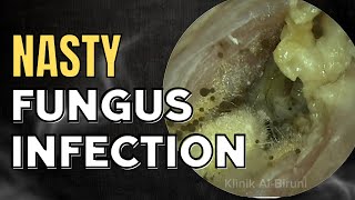 NASTY Fungus Infection Thoroughly Cleaned [upl. by Ahsiuqal]