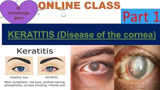 Keratitis disease of the cornea [upl. by Lam]