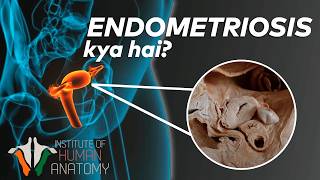 Endometriosis kya hai in Hindi [upl. by Enotna]