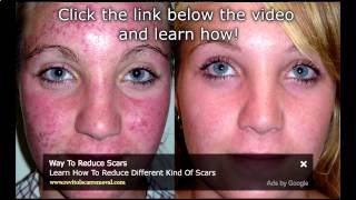 Watch Bio Oil Acne Scars Before amp After Results  Bio Oil Acne Scars Before And After [upl. by Novyat]