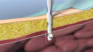 CarterThomason® II Port Closure System [upl. by Chabot]