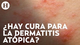 Dermatitis atópica Qué la causa cuáles son los síntomas y qué tratamientos hay  Médico H [upl. by Eiddal]