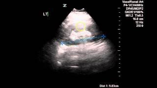 Normal Renal Arterial Doppler  Case Study [upl. by Joel]