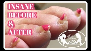 Pedicure Tutorial Elderly Thick Toenails Growing Up Transformation [upl. by Garrison]