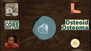 Osteoid Osteoma  Everything You Need To Know  Dr A B Govindaraj mgmhelathcare [upl. by Borrell]