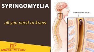 Syringomyelia  All about Syringomyelia from Introduction to Treatment  In Hindi  Mera Physio [upl. by Areis726]