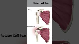 rotator cuff muscle testing rotator cuff muscle tear anatomy muscle youtubeshorts [upl. by Fahland]