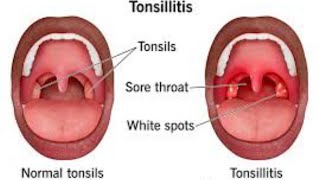 شرح Tonsillitis بالتفصيل 💗💯🔥 [upl. by Ahsikahs]