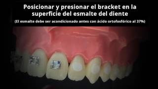 Biodinâmica España  Biofix Adhesivo fotocurable para pegar brackets [upl. by Erodroeht236]