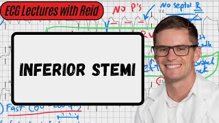 Inferior STEMI  Day 24 ECG Challenge [upl. by Bethany]