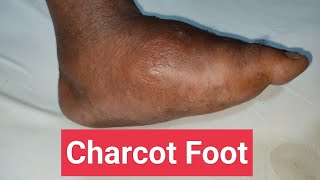 Understanding Charcot Foot in Diabetes Symptoms Treatment and Care [upl. by Aphrodite]