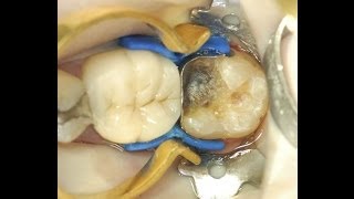 Restoring the difficult class II cavity with composite utilizing the ABC Wedge [upl. by Tannie]