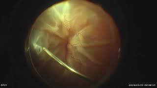 Surgery of funnel shaped retinal detachment hopeless or not [upl. by Henke]