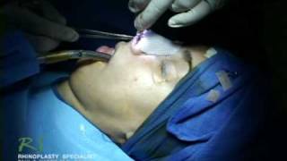 Dr Nassifs Closed Rhinoplasty How To  Exposing Nasal Skeleton [upl. by Ahsimit]