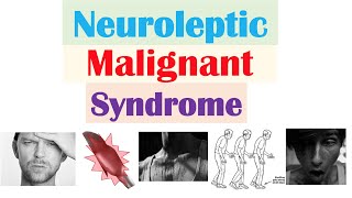 Neuroleptic Malignant Syndrome  Causes Pathophysiology Symptoms Diagnosis Treatment [upl. by Asselem]