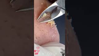 Skincare  Blackheads Removal 195 skincare skincare blackheads blackheads [upl. by Marcy]