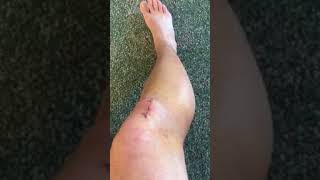 Osgood Schlatter Surgery Day 11 [upl. by Stanford]