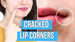 Angular cheilitis causes amp treatments a QampA with dermatologist Dr Dray [upl. by Willock440]