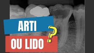 ARTICAÍNA OU LIDOCAÍNA PARA ANESTESIA INTRALIGAMENTAR EM MOLAR INFERIOR  QUICK TIP ENDOLOVERS [upl. by Eibrad]