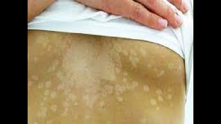 Tinea Versicolor Fungal infection Sehua का सही इलाज। Dr Sandesh Gupta Dermatologist [upl. by Adigirb]