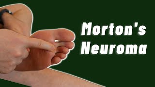 Top Progressive Exercises for Mortons Neuroma Relief  Irish Physios Guide [upl. by Adnarrim]