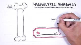 Haemolytic Anaemia  classification intravascular extravascular pathophysiology investigations [upl. by Ahsenaj15]