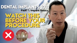 Dental Implants 101 What You NEED to Know Part 1 Implant Basics [upl. by Pembrook]