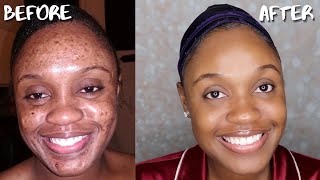 AFFORDABLE SKIN CARE ROUTINE FOR ACNE DARK MARKS AND HYPERPIGMENTATION [upl. by Ennayk]