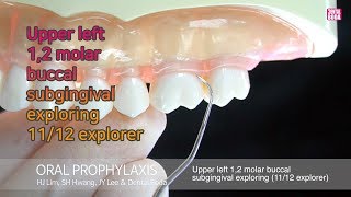 Upper left 12 molar buccalsubgingival exploring 1112 explorer [upl. by Naam63]