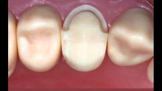 Metal Ceramic Crown Preparation on Premolar FourthMolar com [upl. by Ynattib]