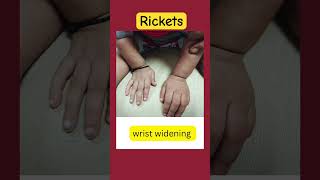 Signs of rickets in children  findings of rickets  youtubeshortsviralvideopediatricians [upl. by Bernete]