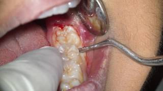 Wisdom Tooth Extraction Without Forceps EWF  Dr Fabio Cozzolino Zerodonto [upl. by Asiel]