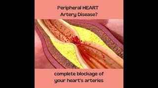 Complete Heart Blockage  Symptoms of Heart Attack [upl. by Ynomrah608]