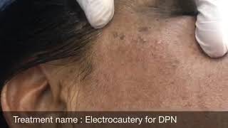 Dermatosis Papulosa Nigra Removal DPN Removal Poise Skin Clinic [upl. by Urana]