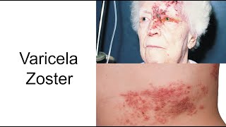 Varicela Zoster  Herpes Zoster  Conoce la enfermedad [upl. by Yajeet577]