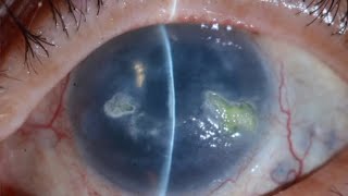 PERSISTENT CORNEAL EPITHELIAL DEFECT [upl. by Annirac]