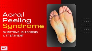 Acral Peeling Syndrome Symptoms Diagnosis and Treatment [upl. by Aikam]