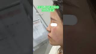 ヒアルロン酸注射だけで骨切りみたいな変化！！ 美容整形 鼻ヒアル 鼻先ヒアル [upl. by Chainey6]