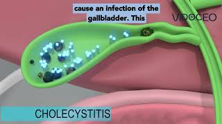 Acute cholecystitis explained [upl. by Latashia]