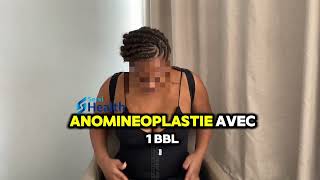 Témoignage d’une patiente satisfaite par sa liposuccion avec abdominoplastie et bbl avec SERVIHEALTH [upl. by Lewls531]