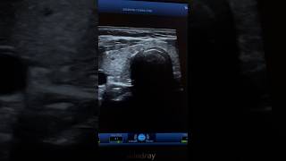 Hashimoto Tyroiditis Ultrasound  Hypothyroidism Sonography  ARDMS [upl. by Belcher118]