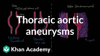 Thoracic aortic aneurysms  Circulatory System and Disease  NCLEXRN  Khan Academy [upl. by Ramsdell176]