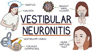 Understanding Vestibular Neuronitis [upl. by Swiercz]