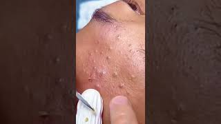 Huge Blackhead Extraction Extremely Satisfying [upl. by Niuq]