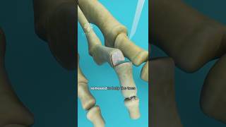 What is Hammer Toe and How to Fix It shorts viralvideo  Creativelearning3d [upl. by Holey]