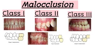 malocclusionsClass IClass IIClass IIIClinical featuresQuick Revision [upl. by Andre525]