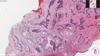 Ameloblastoma Conventionalmulticystic type [upl. by Yrellih]